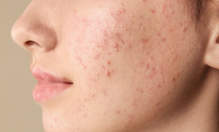 Skin care for acne-prone skin 