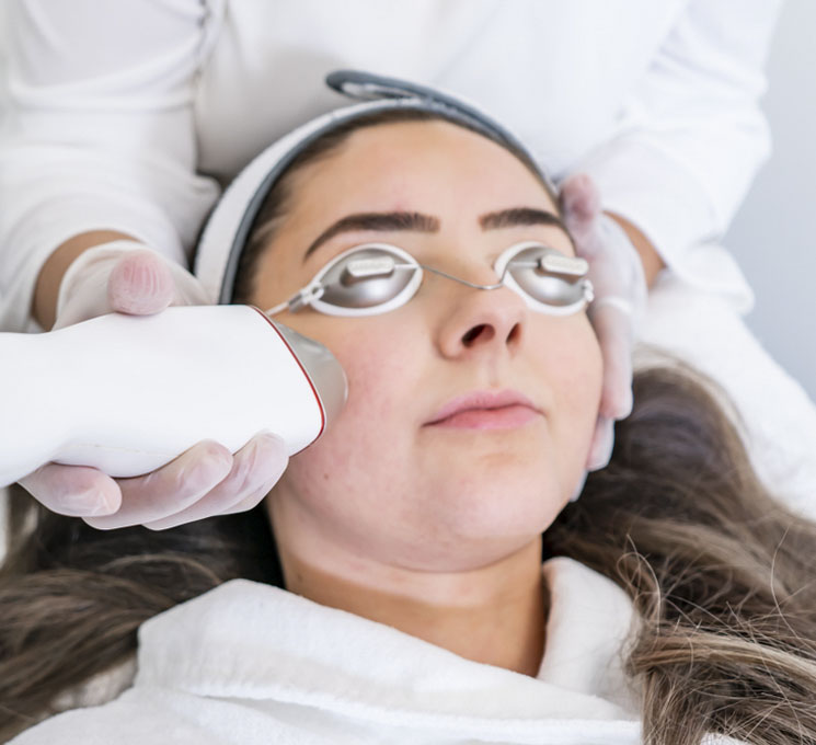 Microneedling-Radio-Frequency