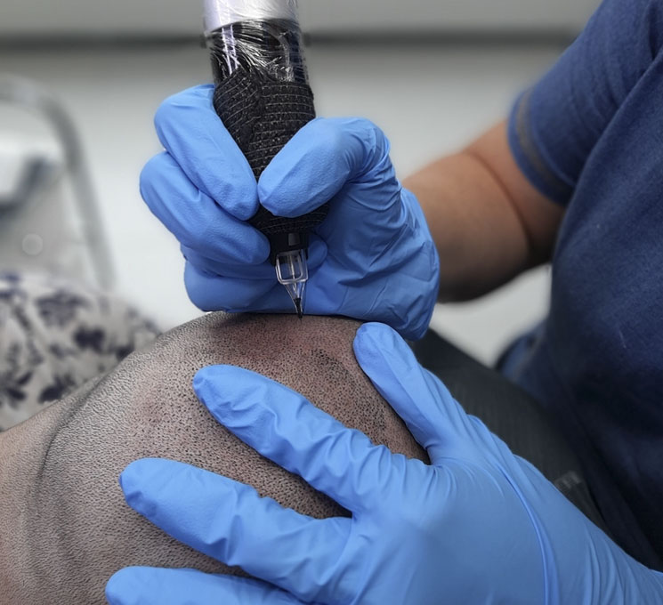 Scalp-Micropigmentation