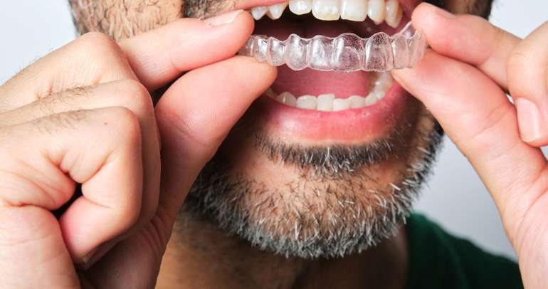 Exploring the Benefits of Choosing Clear Aligners Over Traditional Braces