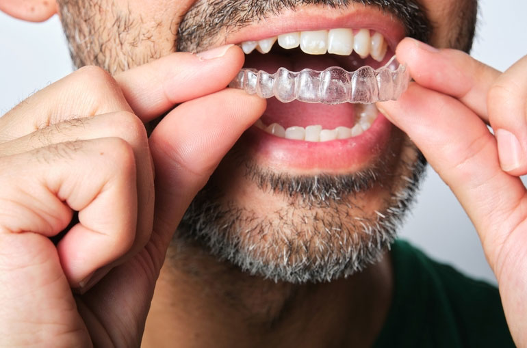 Exploring the Benefits of Choosing Clear Aligners Over Traditional Braces